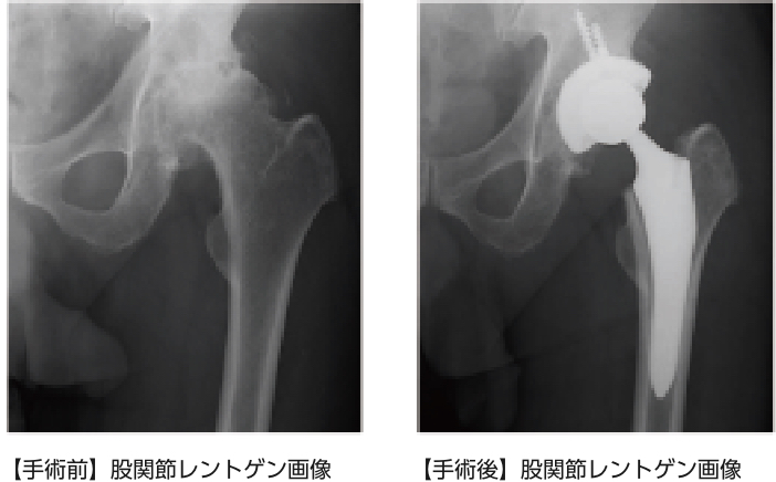 人工股関節置換術（THA） - 整形外科 猫山宮尾病院（膝関節・股関節