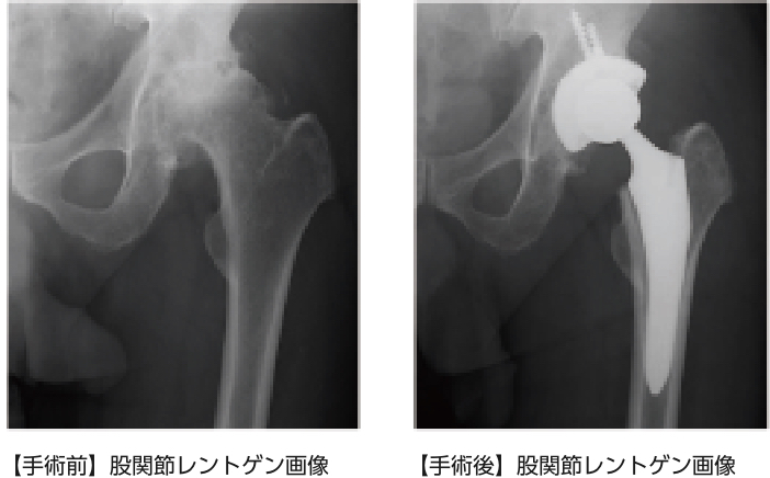 人工股関節全置換術 - 健康/医学